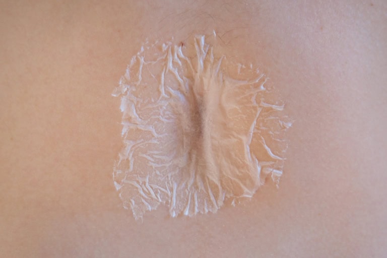 Eine querformatige farbige Fotografie. Im Detail sieht man einen nackten Bauch. dort wo man den Bauchnabel sehen würde, klebt eine dünne transparente Schicht wie ein Papier darüber.