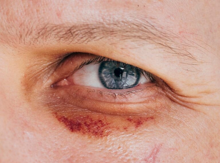 Nahaufnahme eines Auges mit Blutergerguss aus der Serie Blauer Schatten von Thomas Victor